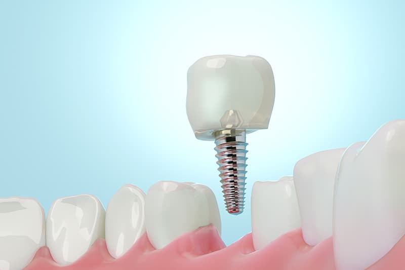 Single Tooth Implants