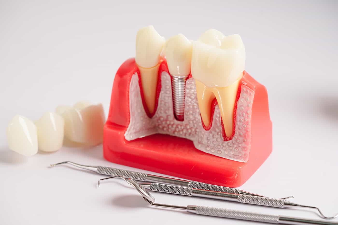 Dental Implant